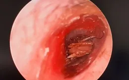 Gián bất ngờ chui vào tai, người bệnh suýt thủng màng nhĩ