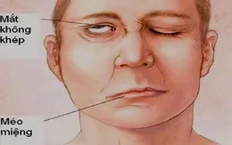 Miệng méo, mắt không nhắm kín do tắm ngay khi tập thể dục buổi sáng