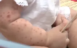 Số ca mắc tay chân miệng gia tăng tại TP. Hồ Chí Minh