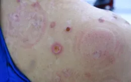 Viêm loét, bỏng da vì đốt ngải, đốt hương trị đau nhức vai gáy