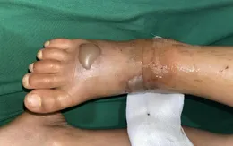 Cảnh báo nguy cơ bị rắn cắn khi trời mưa nhiều