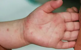 Gia tăng bệnh nhi mắc tay chân miệng ở ĐBSCL