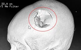 Xuyên đêm phẫu thuật cứu bệnh nhi bị vỡ lún xương sọ do ngã