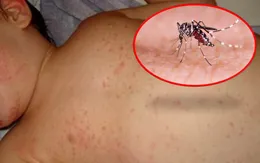 Đắk Lắk: Một bệnh nhi tử vong do sốt xuất huyết Dengue