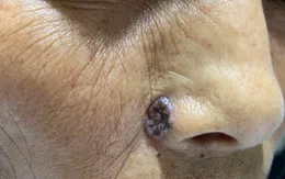 Lầm tưởng là nốt ruồi, đi khám phát hiện ung thư da hiếm gặp