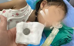 Cấp cứu thành công bé gái 3 tuổi mắc đồng xu trong thực quản
