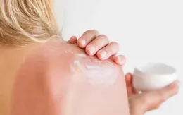 18 nguy cơ tổn hại sức khỏe khi làn da bị cháy nắng