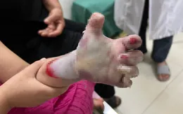 Cảnh báo: Tai nạn thương tâm từ máy ép mía