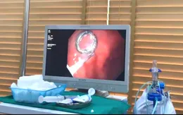 Bé trai nhập viện vì nuốt phải móc khóa