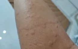 Sốc phản vệ độ 3 vì bị kiến đốt
