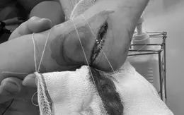 Người lớn bất cẩn, bé 3 tuổi bị dao cứa đứt gân chân