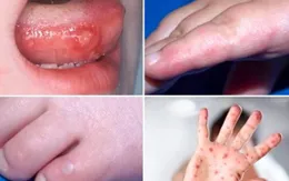 Bình Dương: Nhắn tin cho người dân cảnh báo về bệnh tay chân miệng