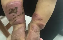 Người nhà tự ý sử dụng lá cây điều trị viêm da cơ địa, bệnh nhi 11 tháng tuổi bị hoại tử nặng nề