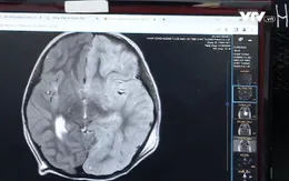 Trẻ nguy kịch do bệnh não cấp hiếm gặp