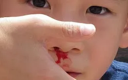 5 bước xử trí khi trẻ bị chảy máu cam