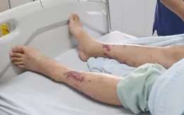 Sốc nhiễm khuẩn nguy kịch do nhiễm liên cầu khuẩn lợn