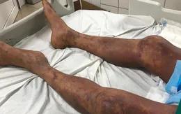 Suy đa tạng nguy kịch sau khi làm và ăn thịt lợn ốm