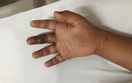 Cảnh báo tình trạng rắn cắn trong mùa mưa