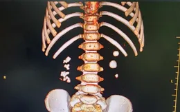 Bé trai 3 tuổi đi khám vì đau thắt lưng, đau mạn sườn, bác sĩ phát hiện bị sỏi thận 2 bên