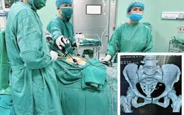 Dụng cụ tránh thai lạc chỗ xuyên thủng ruột