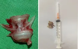 Nội soi gắp mảnh xương cá lớn cắm sâu trong thực quản người bệnh