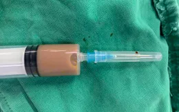 "Tiền mất, tật mang" vì tiêm thuốc không rõ nguồn gốc điều trị đau vùng thắt lưng