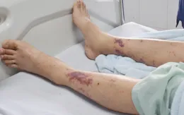 Cảnh báo nguy cơ tử vong do nhiễm liên cầu lợn