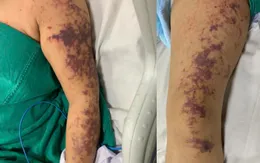 Người phụ nữ mắc liên cầu khuẩn sau khi ăn lòng lợn