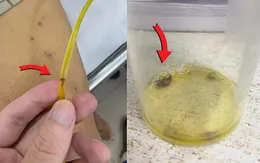 Hy hữu: Sán lá gan chui ra từ ống dẫn lưu đường mật