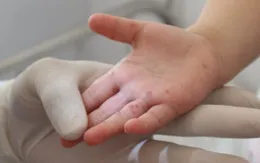 Nâng cao ý thức phòng bệnh tay chân miệng đang diễn biến phức tạp