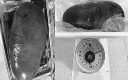 Cắt lách nặng 4kg cho bệnh nhân xơ hóa tủy cấp