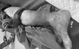 Cảnh báo: Bệnh nhân bị chó nhà nuôi cắn đứt rời bàn chân