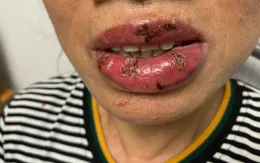 Cẩn trọng với biến chứng khi xăm môi