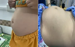 Cắt bỏ khối u buồng trứng nặng hơn 6kg cho bé gái 9 tuổi