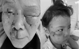 Chó nhà tấn công: Cụ bà phải múc nhãn cầu, bé gái bị rách má