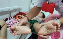 Đắk Lắk: Gần 1.200 ca mắc, 3 ca tử vong do tay chân miệng