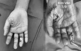 Cảnh báo tai nạn bỏng điện ở trẻ nhỏ