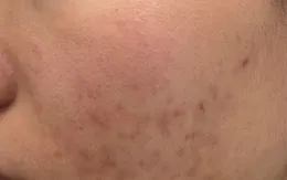 "Peel da" - có nên thực hiện tại nhà?