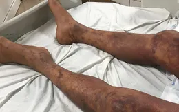 Cảnh báo nguy cơ tử vong do nhiễm liên cầu lợn