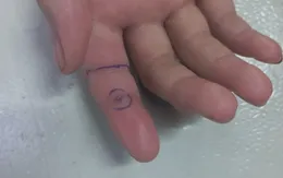 Chơi ở sân nhà, 2 bé gái sinh đôi bị rắn hổ mang cắn