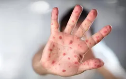 Cả nước đã có 21 ca tử vong do tay chân miệng