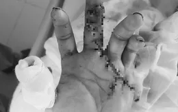 Trả lại bàn tay lành lặn cho bệnh nhân bị đứt lìa 2 ngón tay