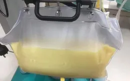 Thay huyết tương cứu sống bệnh nhân bị viêm tụy cấp do tăng mỡ máu