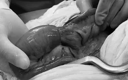 Cảnh giác với bệnh lồng ruột cấp tính khi trẻ đau bụng từng cơn