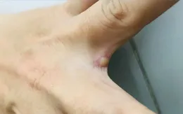 6 biện pháp phòng bệnh đậu mùa khỉ