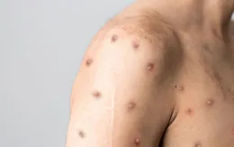 WHO giải đáp những câu hỏi đáng quan tâm về bệnh đậu mùa khỉ