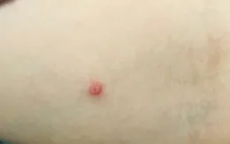Bộ Y tế: Tăng cường điều trị ca mắc đậu mùa khỉ, không để xảy ra lây nhiễm chéo