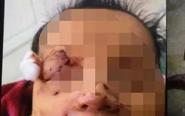 Bé sơ sinh nghi bị chuột cắn nhiều vết thương ở mặt