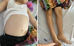 Tự ý ngừng điều trị hội chứng thận hư, bé trai suýt nguy kịch