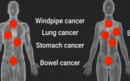 Gia tăng bệnh nhân ung thư dưới 50 tuổi